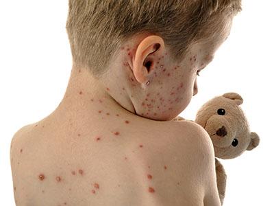 Young child with measles holding a teddy bear