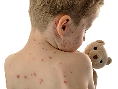 Young child with measles holding his teddy bear